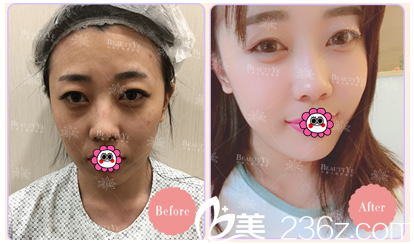 北京葉美人內(nèi)切法祛眼袋讓您重獲靈動(dòng)雙眼，價(jià)格需2980元起