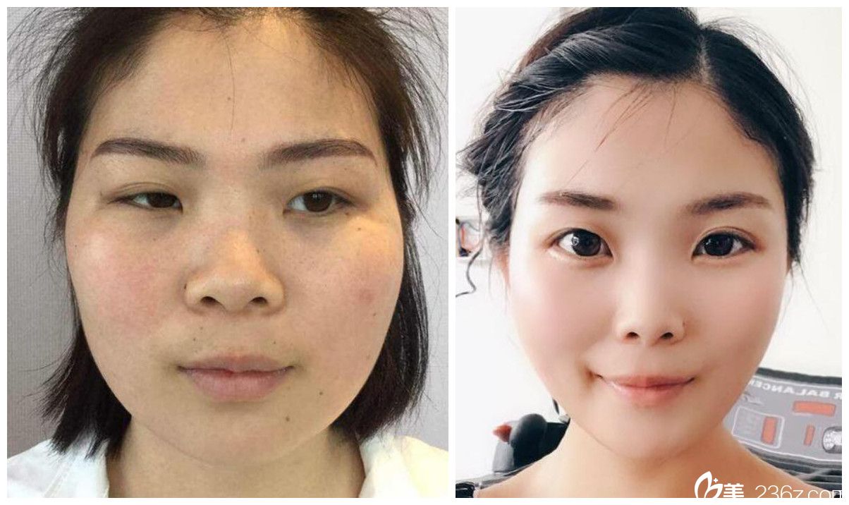 去合肥臺(tái)美麗格整形注射瘦臉除皺瘦臉瘦臉案例前后效果對(duì)比照片