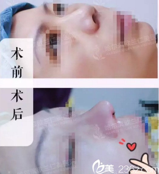 達(dá)拉斯藝術(shù)美鼻真人案例前后對(duì)比照