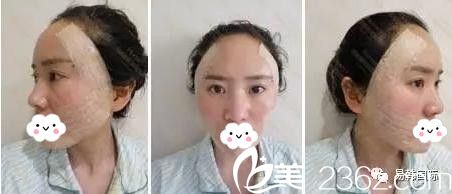 易韓安和美容整形醫(yī)院張鶴明做自體脂肪填充后三天