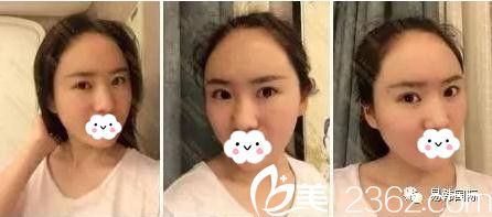 易韓安和美容面部脂肪填充術(shù)后四天