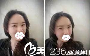 信陽(yáng)做面部脂肪填充哪家醫(yī)院好?看看我在易韓找張鶴明院長(zhǎng)填充的心形臉效果就知道