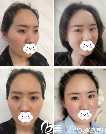 安和美容整形醫(yī)院脂肪填充前后對比