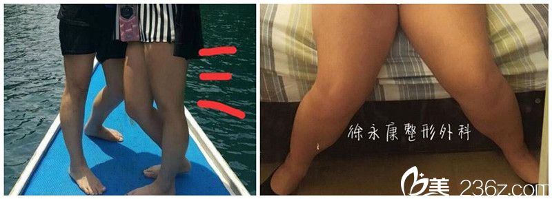 在中國臺灣徐永康整形做吸脂前肥胖 在中國臺灣徐永康整形做吸脂前肥胖