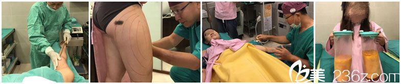 徐永康醫(yī)生為我設(shè)計吸脂方案 徐永康醫(yī)生為我設(shè)計吸脂方案