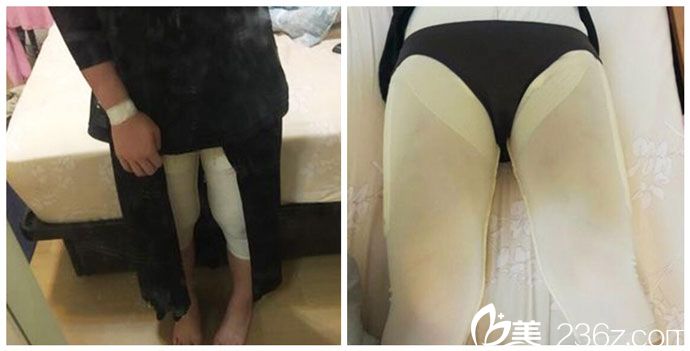 吸脂后穿著塑身衣 吸脂后穿著塑身衣