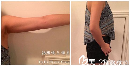 徐永康醫(yī)生做三合一吸脂術(shù)后恢復三個月 徐永康醫(yī)生做三合一吸脂術(shù)后恢復三個月