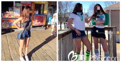 麒麟臂、粗壯腿找中國(guó)臺(tái)灣徐永康醫(yī)師做三合一抽脂術(shù)吸出3800cc恢復(fù)后告別吃酵素