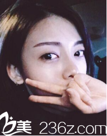 尹賢哲假體隆鼻術(shù)后一個月 尹賢哲假體隆鼻術(shù)后一個月