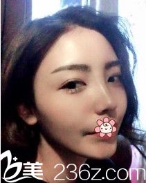 韓國nplus整形外科隆鼻技術(shù)怎么樣 韓國nplus整形外科隆鼻技術(shù)怎么樣