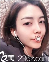 我找了個專門做隆鼻手術(shù)的韓國nplus整形外科尹賢哲院長做的硅膠隆鼻+耳軟骨墊鼻尖。