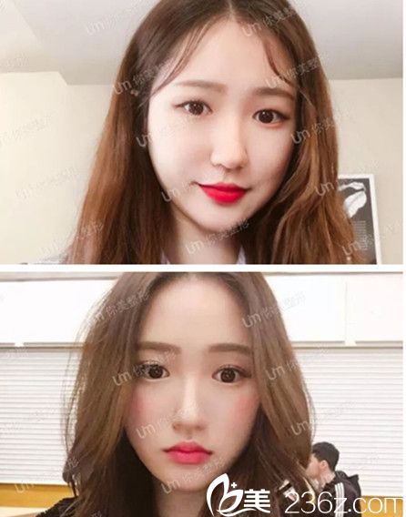 李磊院長(zhǎng)切開(kāi)雙眼皮+開(kāi)眼角真人案例 李磊院長(zhǎng)切開(kāi)雙眼皮+開(kāi)眼角真人案例