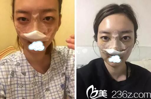 <!--<i data=20240703-sp></i>-->華美悅美整形鼻綜合術后即刻 <!--<i data=20240703-sp></i>-->華美悅美整形鼻綜合術后即刻