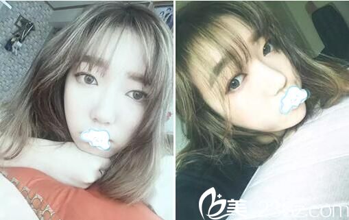 隆鼻手術后2個月恢復圖片 隆鼻手術后2個月恢復圖片