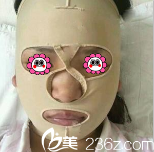 醫(yī)生給我做顴骨顴弓整形術后當天樣子