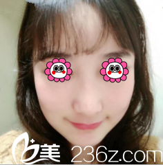 了解到羅金超磨骨技術(shù)不錯(cuò)后我在北京聯(lián)合麗格做了顴骨顴弓整形術(shù)