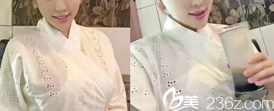 做完假體隆胸7天拆線效果圖