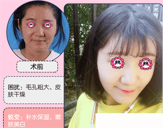 北京美萊2019年1月特惠價(jià)格表公布！小氣泡38元，無(wú)針99元