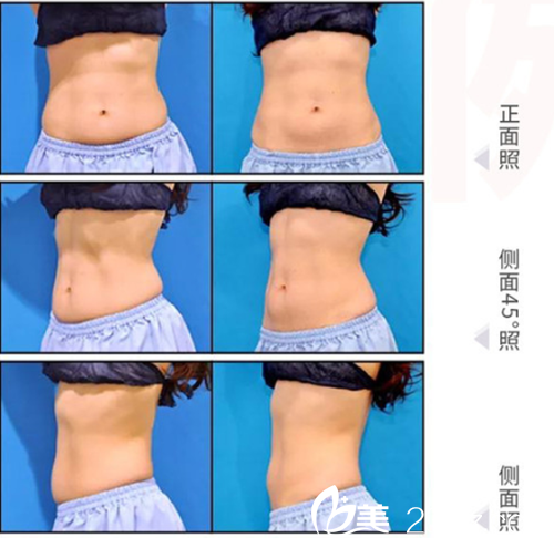 日本加藤clinic麻布醫(yī)院冷凍溶脂案例 日本加藤clinic麻布醫(yī)院冷凍溶脂案例