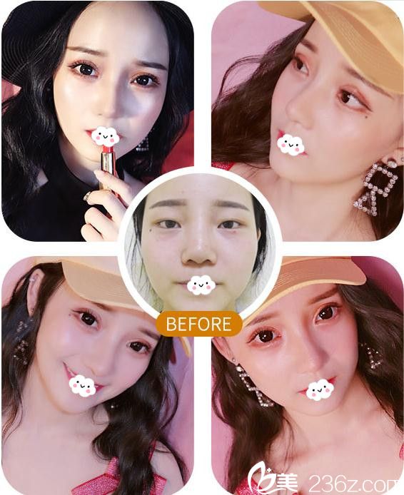 武漢美立方胡江偉院長雙眼皮修復(fù)案例 武漢美立方胡江偉院長雙眼皮修復(fù)案例