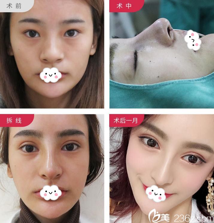 武漢美立方胡江偉鼻綜合隆鼻恢復(fù)圖 武漢美立方胡江偉鼻綜合隆鼻恢復(fù)圖