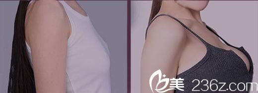 武漢美立方胡文亞假體隆胸案例 武漢美立方胡文亞假體隆胸案例