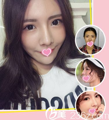 藍山整形醫(yī)院隆鼻案例 藍山整形醫(yī)院隆鼻案例