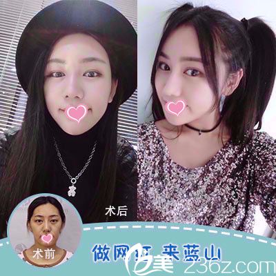 石家莊藍山脂肪填充面部案例 石家莊藍山脂肪填充面部案例