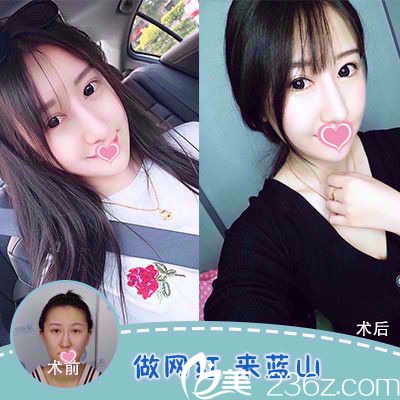 藍山整形醫(yī)院做雙眼皮案例 藍山整形醫(yī)院做雙眼皮案例