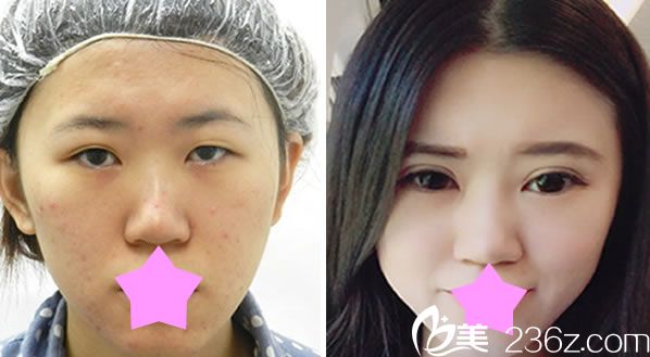 張世幸做眼綜合+全切雙眼皮對(duì)比圖 張世幸做眼綜合+全切雙眼皮對(duì)比圖