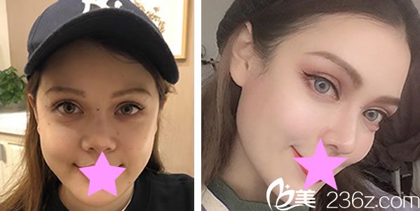 陳大正耳軟骨隆鼻對(duì)比圖 陳大正耳軟骨隆鼻對(duì)比圖