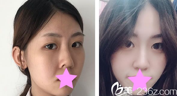 韓風(fēng)時(shí)尚整形醫(yī)院陳怡傑院長(zhǎng)面部線雕提升對(duì)比圖 韓風(fēng)時(shí)尚整形醫(yī)院陳怡傑院長(zhǎng)面部線雕提升對(duì)比圖