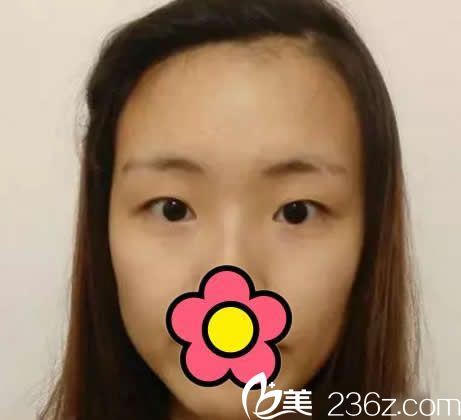 <!--<i data=20240703-sp></i>-->整形割雙眼皮前 <!--<i data=20240703-sp></i>-->整形割雙眼皮前