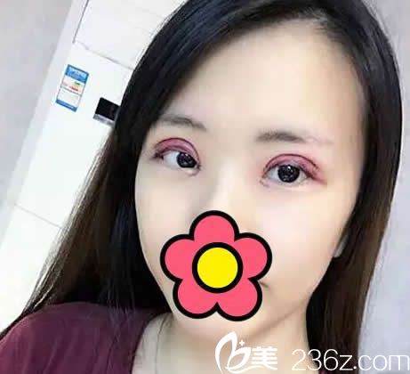 全切雙眼皮第二天 全切雙眼皮第二天