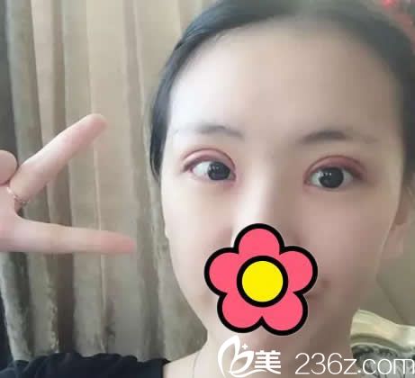 割雙眼皮開眼角第四天效果 割雙眼皮開眼角第四天效果