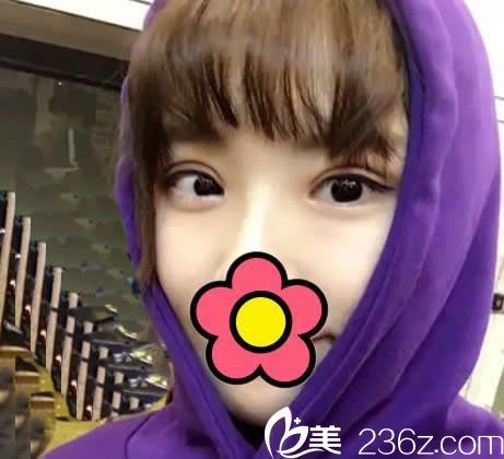 <!--<i data=20240703-sp></i>-->整形切開雙眼皮半個月 <!--<i data=20240703-sp></i>-->整形切開雙眼皮半個月