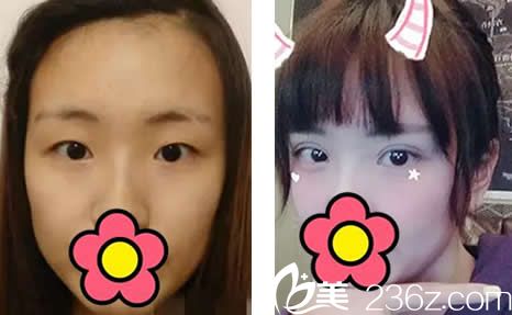 看了我在整形割雙眼皮+開眼角一個月的效果后 朋友都說這樣的價格太值了