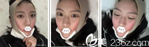 剛做完面部吸脂戴的頭套 剛做完面部吸脂戴的頭套