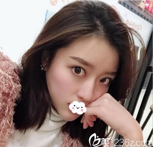 四川達(dá)州雙均面部吸脂術(shù)后一個月恢復(fù)自然，效果比我想的好多了