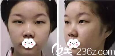 雙眼皮玻尿酸隆鼻術(shù)前照片 雙眼皮玻尿酸隆鼻術(shù)前照片