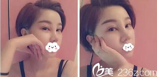 玻尿酸隆鼻術(shù)后11天效果 玻尿酸隆鼻術(shù)后11天效果