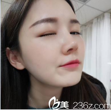 深圳美萊梁曉健隆鼻修復(fù)案例 深圳美萊梁曉健隆鼻修復(fù)案例