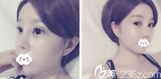 李隆才切開雙眼皮天恢復(fù)照片 李隆才切開雙眼皮天恢復(fù)照片