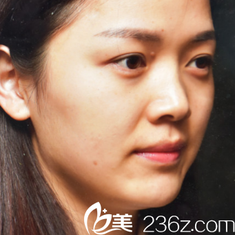 深圳美萊隆鼻修復(fù)術(shù)前照片 深圳美萊隆鼻修復(fù)術(shù)前照片