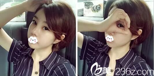 切開雙眼皮+玻尿酸隆鼻術(shù)后一個(gè)月照片 切開雙眼皮+玻尿酸隆鼻術(shù)后一個(gè)月照片