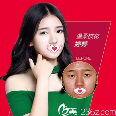 愛(ài)思特雙眼皮真人前后對(duì)比