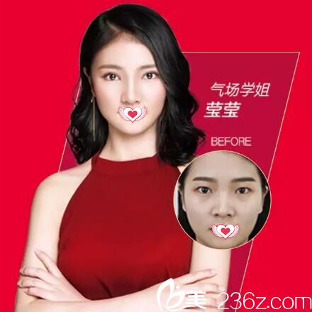 愛(ài)思特鼻整形真人前后效果對(duì)比