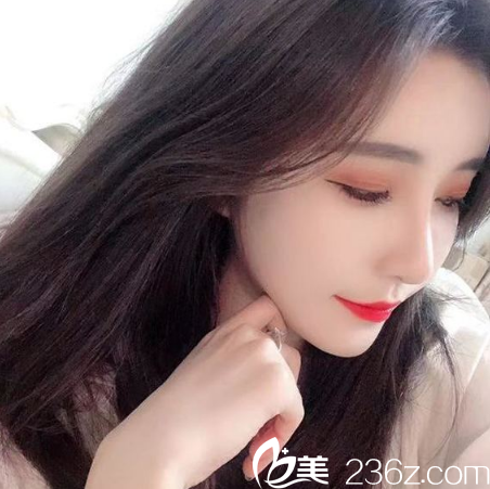 廣州美萊脂肪填充案例7天效果