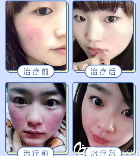 黃健院長激光祛紅血絲真人案例 黃健院長激光祛紅血絲真人案例