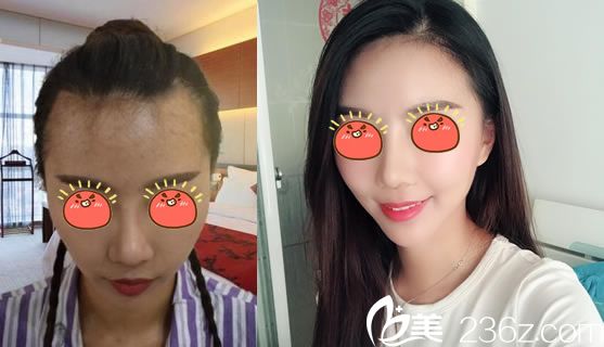 杭州連天美姚寶林種植發(fā)際線案例 杭州連天美姚寶林種植發(fā)際線案例